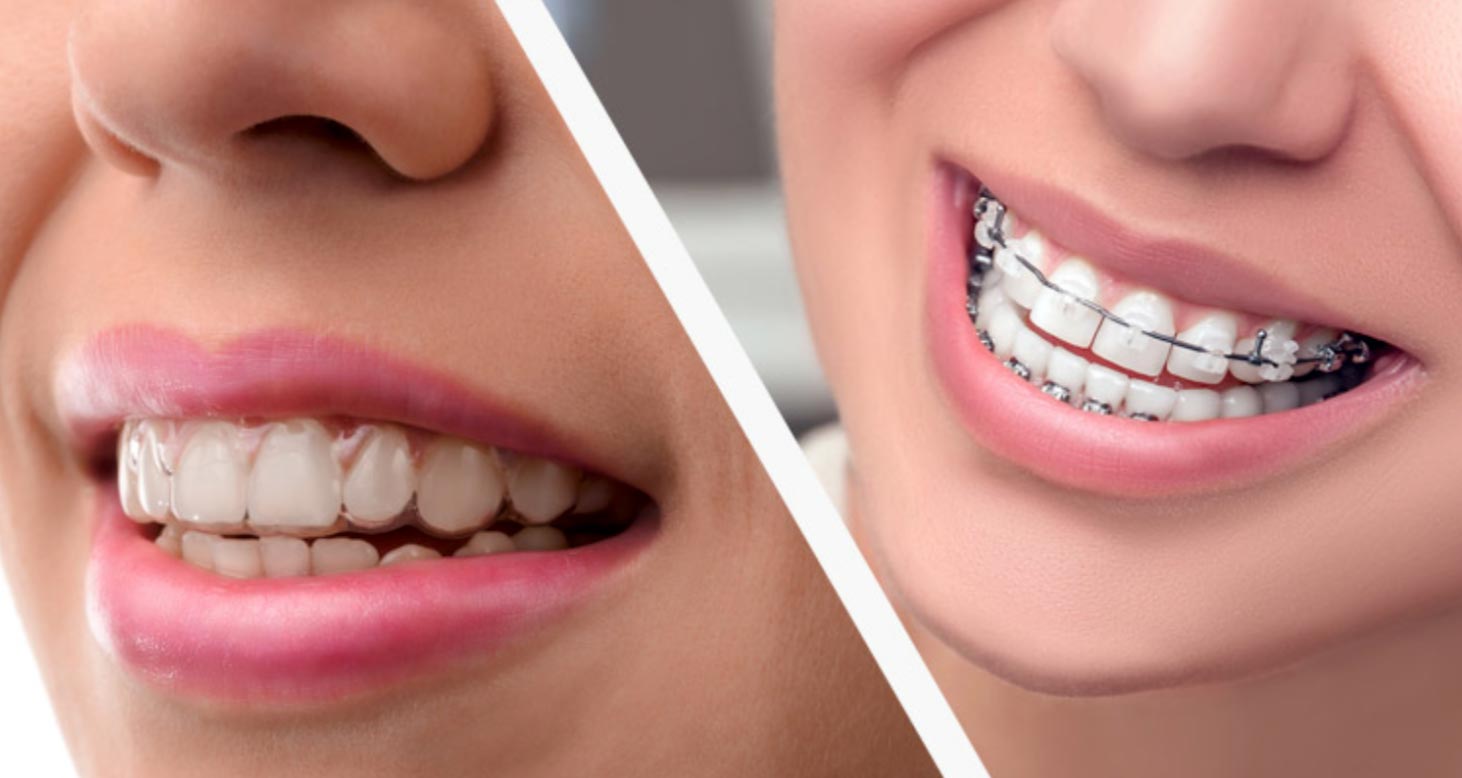 Differences Between Invisalign and Traditional Dental Braces