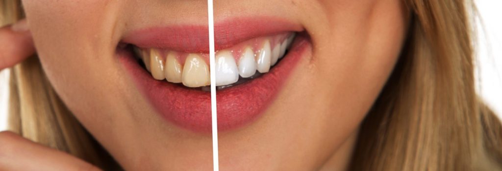 Teeth Whitening in Summerlin